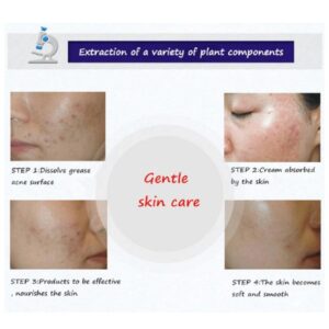 BIOAQUA Anti Acne Cleanser For Removal Of Acne - 100ml